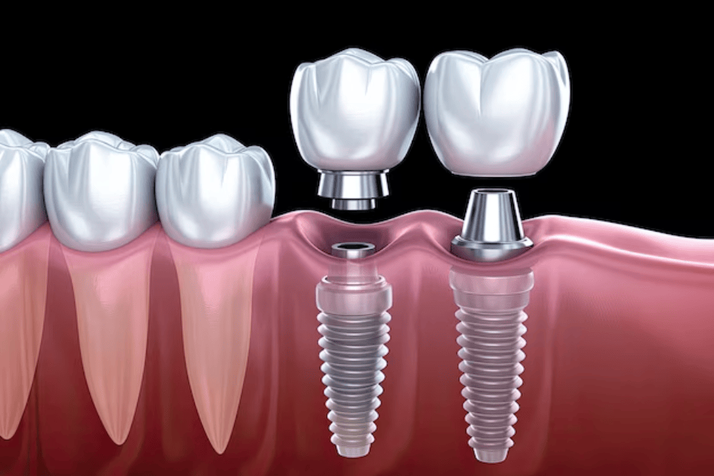 Modern orthodontic treatments at Charizma Dental Clinic